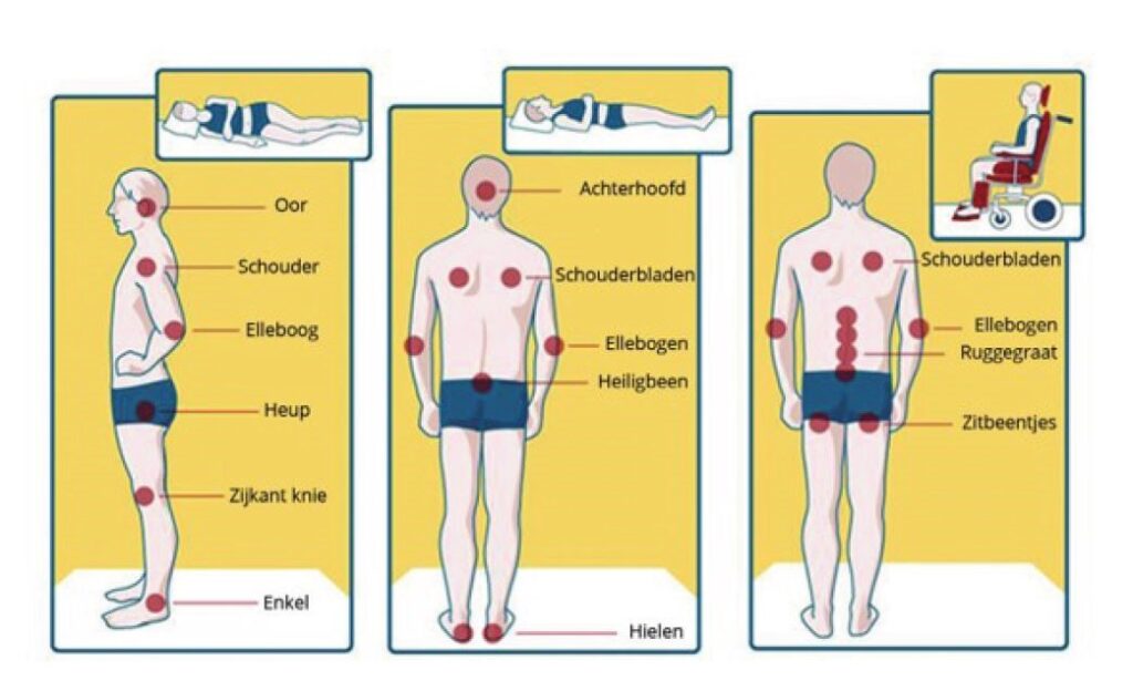 Wat is decubitus?