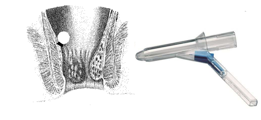 Links: dwarsdoorsnede van de anus, aambeiweefsel en elastieken bandje. Rechts: proctoscoop.